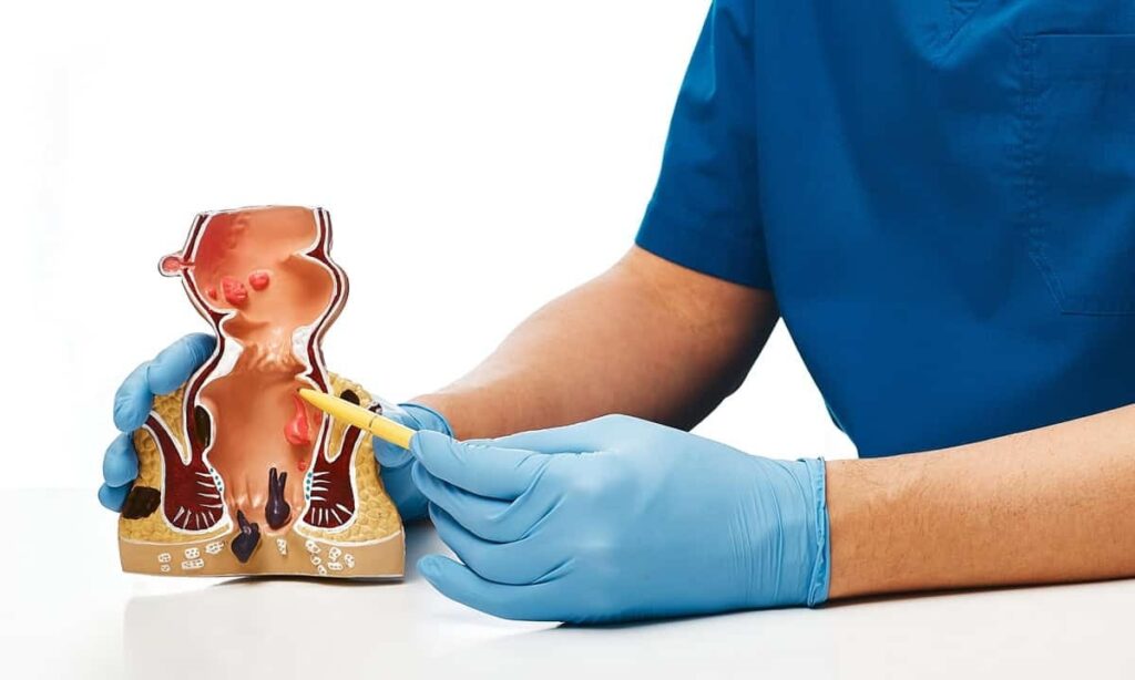 Kronik Anal Fissürün Cerrahi Tedavisi Sfinkterotomi