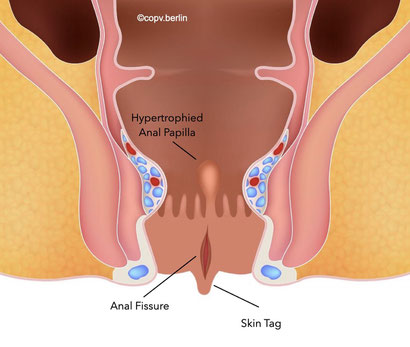 Anal fissür tedavisinde botoks mu ameliyat mı tercih edilmeli?
