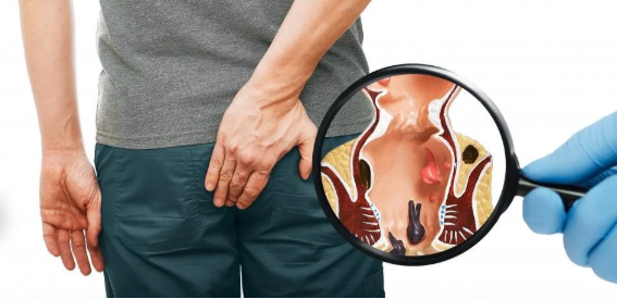 Hemoroid olup olmadığını nasıl anlarsınız ilk belirtileri nelerdir?