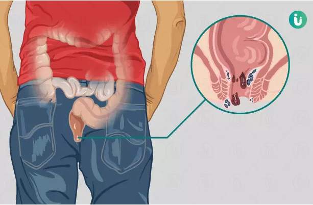 Hemoroid Kanamalarının Tehlikeleri