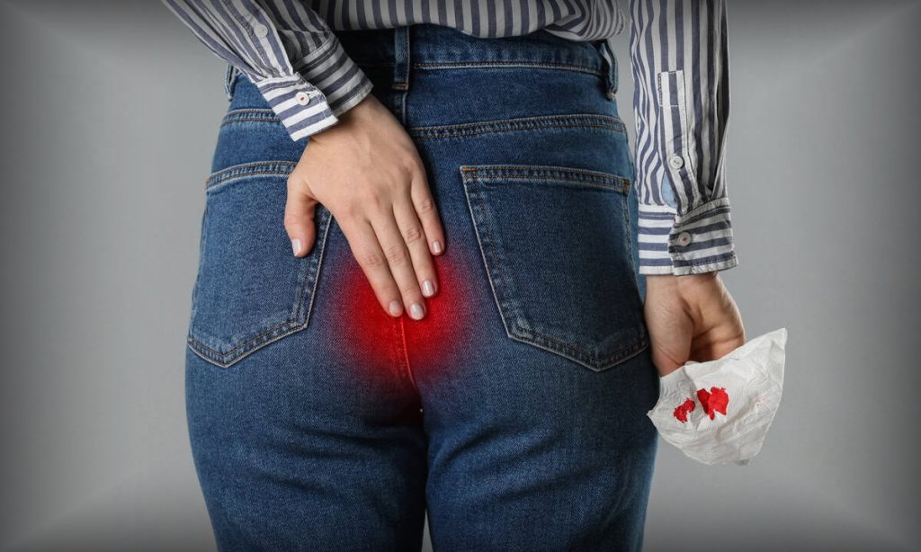 Kanamalı Hemoroid Nasıl Tedavi Edilir?