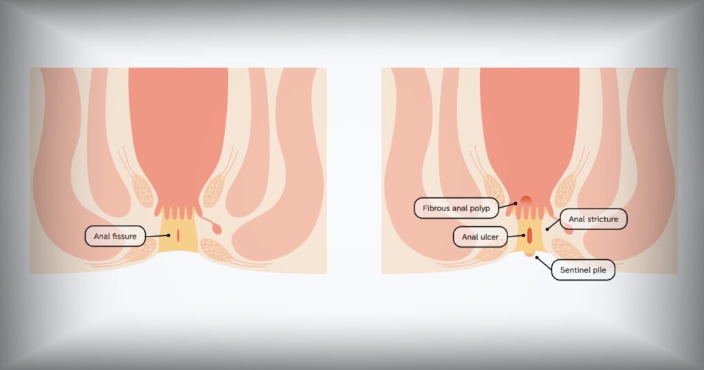 Makat Çatlağı Botoks Yorumları ( Anal Fissür Botoks Yaptıranlar)