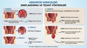 Hemoroidin 4 Derecesi: Hangi Evrede Hangi Yöntem Tercih Edilmeli?